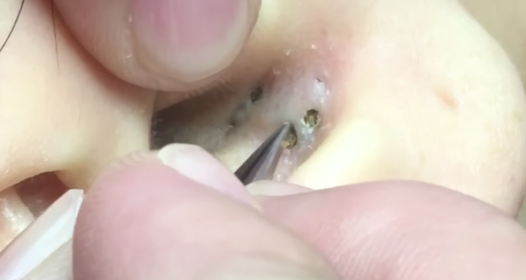 Blackhead removed from ear video