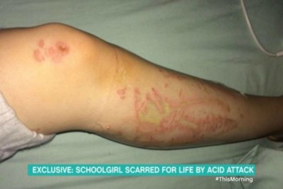 molly young acid attack scars