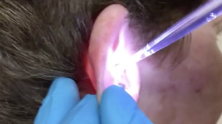 Ear wax removal video