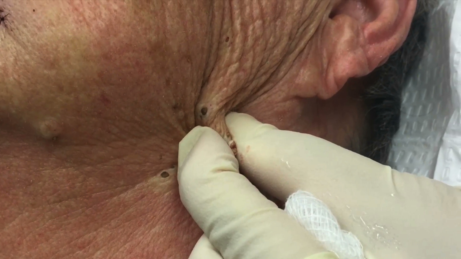 midt i intetsteds stor skøjte The Best Pimple Popping Videos On the Internet