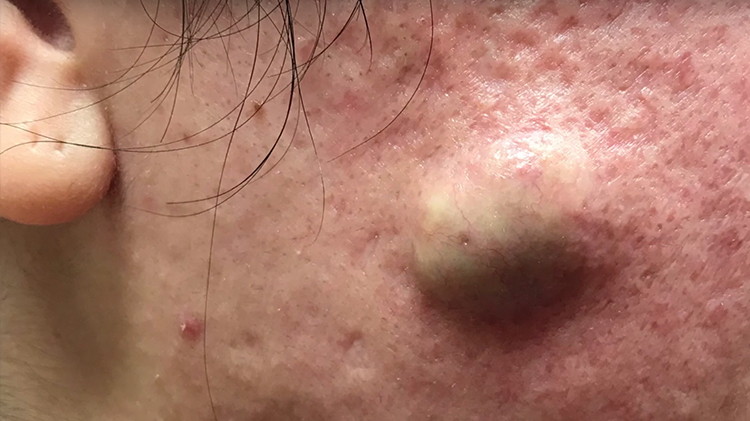 Cyst removal video