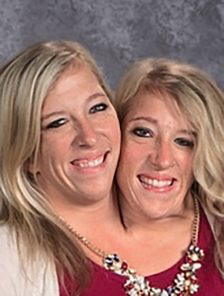 Abby and Brittany Hensel — See What the Famous Conjoined Twins Look
