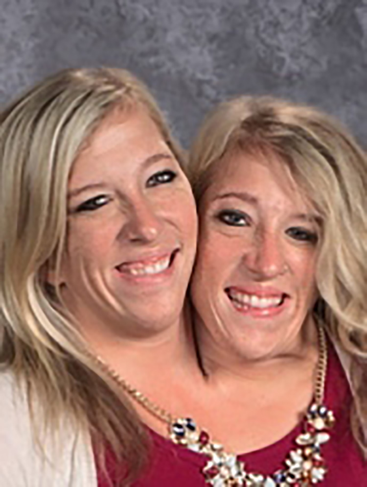 Abby And Brittany Hensel — See What The Famous Conjoined