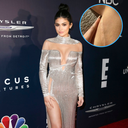 How Did Kylie Jenner Get Her Leg Scar? Childhood Injury Details