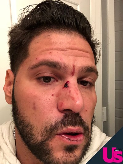 Ronnie Ortiz-Magro Says Jen Harley Allegedly Threw An Ash Tray At His Face Leaving Him Bloody And Bruised