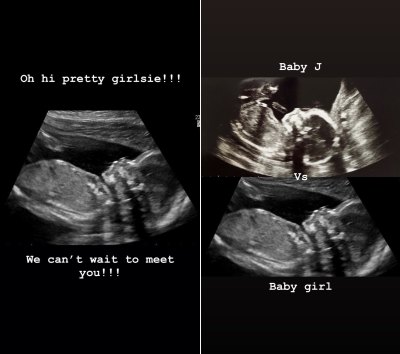 Side-by-Side of Baby Roloff No. 2 Sonogram with Comparison of Baby J and Baby Girl Sonograms