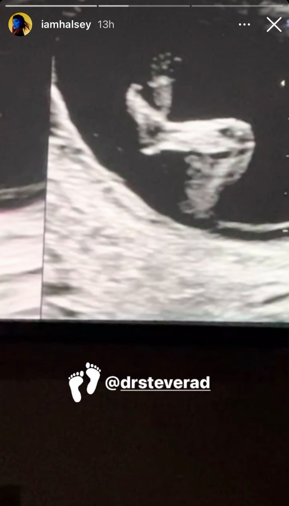 halsey ultrasound pregnant ig 