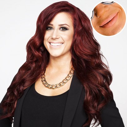 Chelsea Houska Accused Getting Botched Lip Fillers