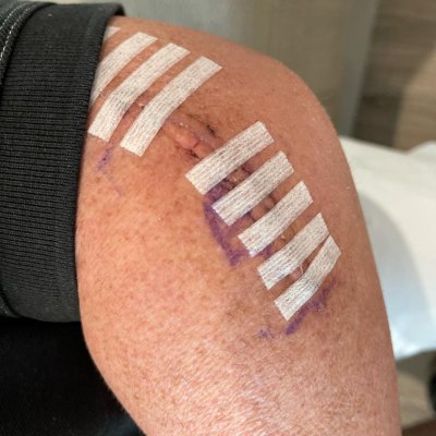 The Little Couple's Bill Klein Shares Photo of Scar After Jen Arnold Removed Stitches Following Arm Surgery