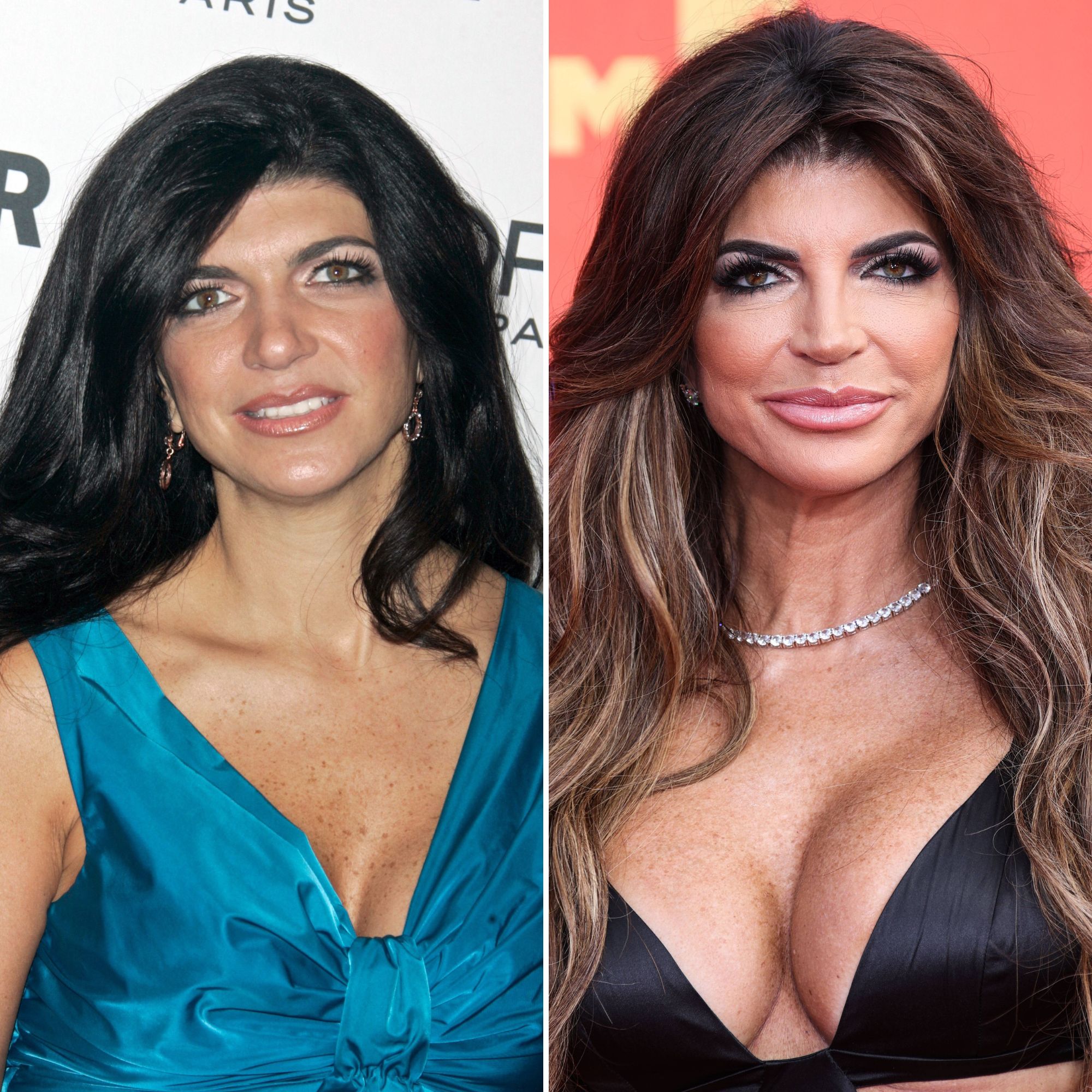 Teresa Giudice Plastic Surgery Photos Before and After