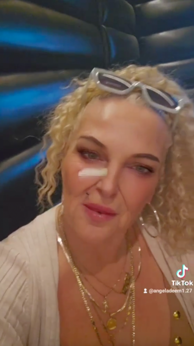 What Happened to '90 Day Fiance' Star Angela Deem's Face? Why She's Wearing a Bandage​
