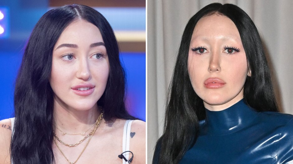 Did Noah Cyrus Ever Have Plastic Surgery? See the Singer’s Transformation Over the Years